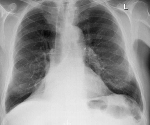 The tumour in the bronchus intermedius is causing partial middle and lower lobe collapse.