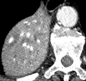 Fluid-filled dilated bronchi beyond a central obstructing carcinoma