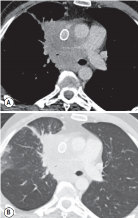 The tumour is obstructing the right main bronchus
