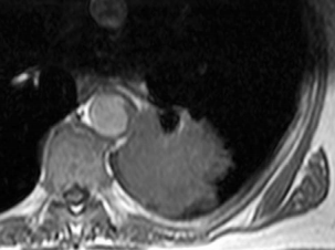 MRI of a left lower lobe tumour that has directly invaded the aortic wall